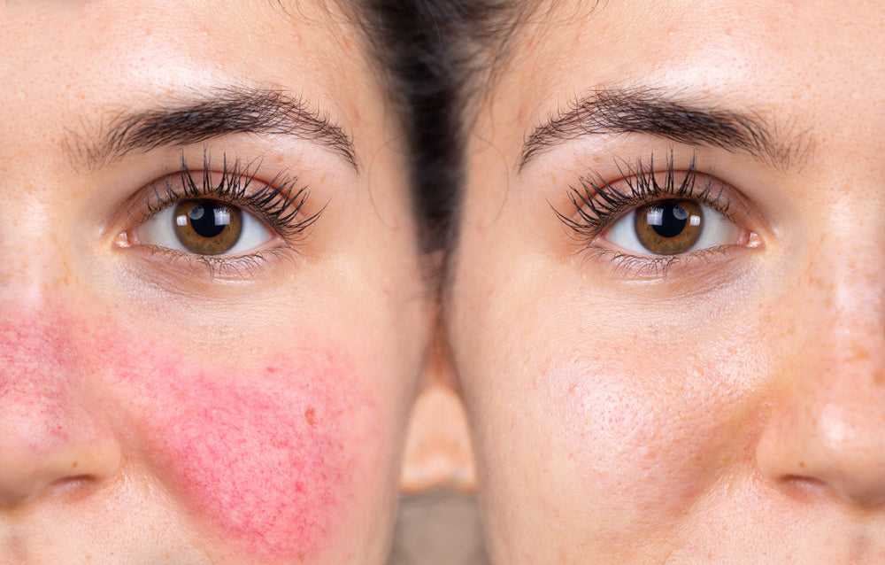 Rosacea - How to treat it naturally and holistically